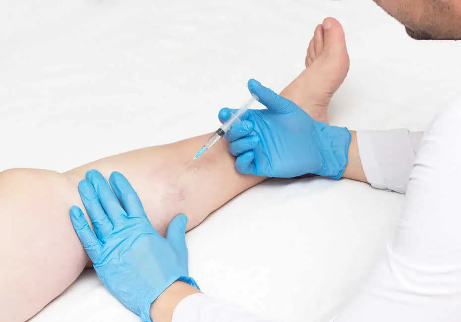 Sclerotherapy by Posh Aesthetics and Wellness in Reading, MA