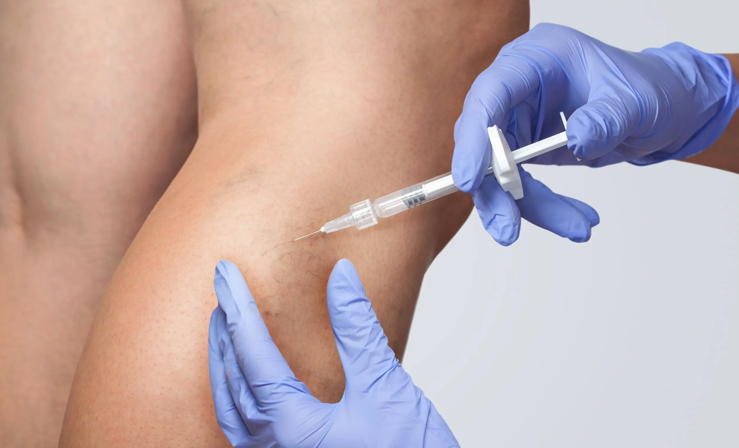 Sclerotherapy in Reading, MA at Posh Aesthetics and Wellness